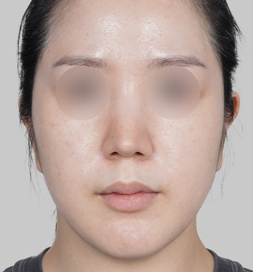 시술 전 (Before)